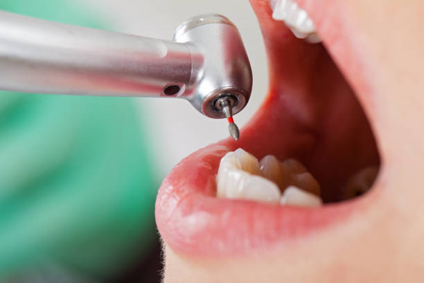 Best Root Canal Emergency Dentist  in Dequincy, LA